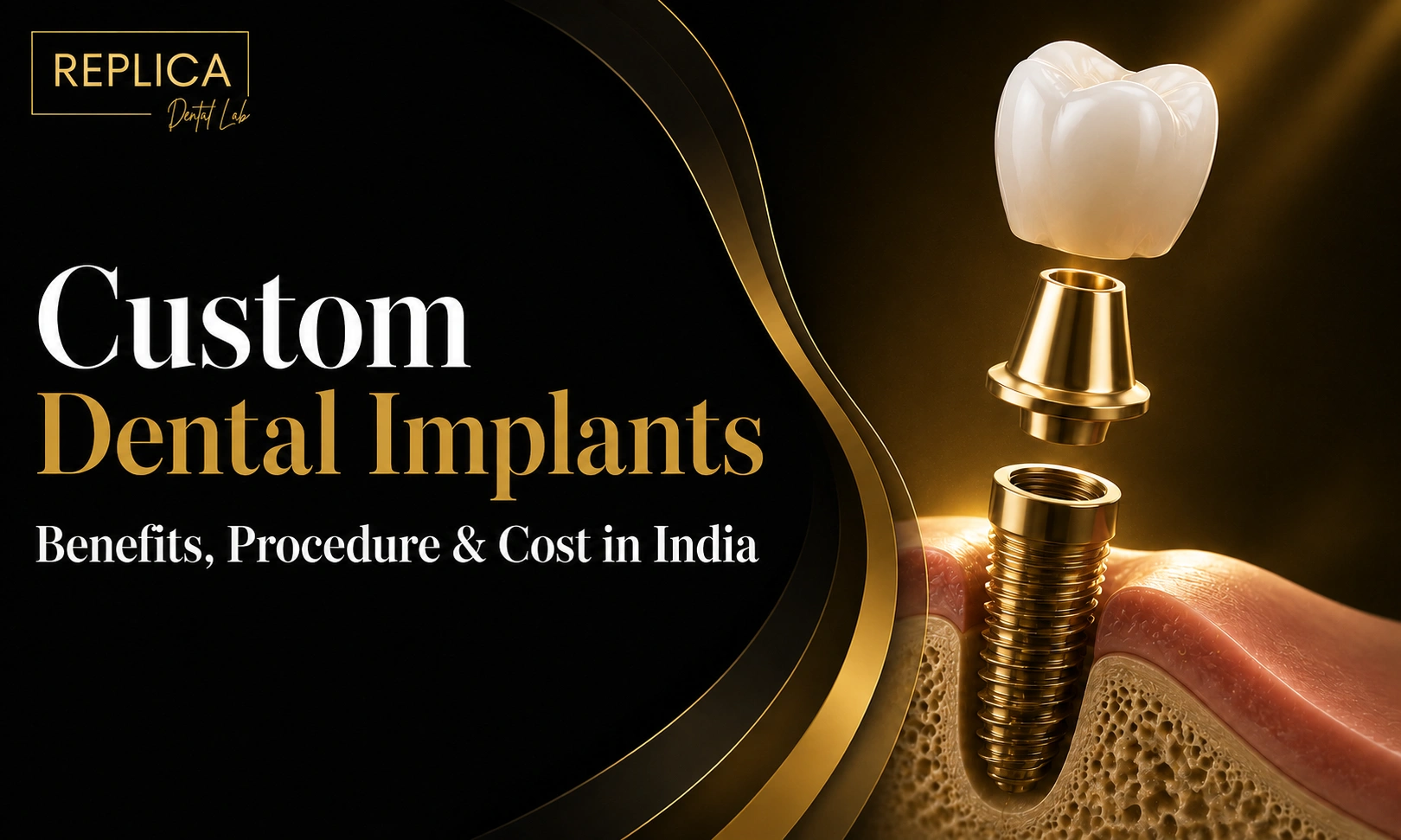 Custom Dental Implants: Benefits, Procedure & Cost in India